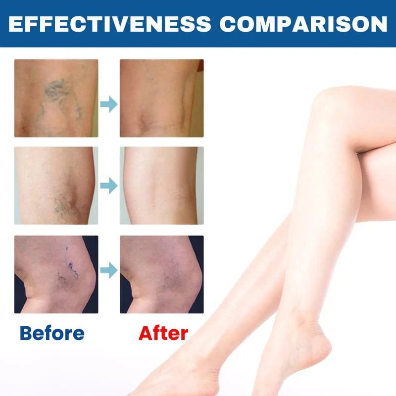 BioEquis Varicose Vein Relief Spray